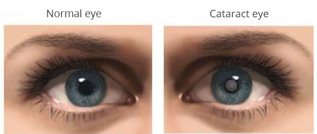 چشم سالم و آب مروارید